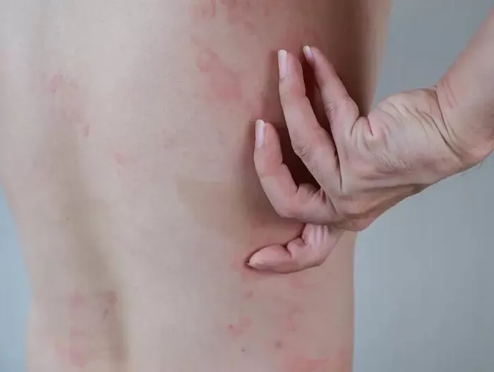 AIDS Belirtileri Vücudun Neresinden Başlar? Kapak Resmi
