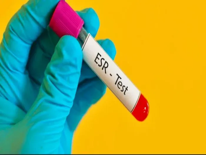 Sedimantasyon Testi Kapak Resmi